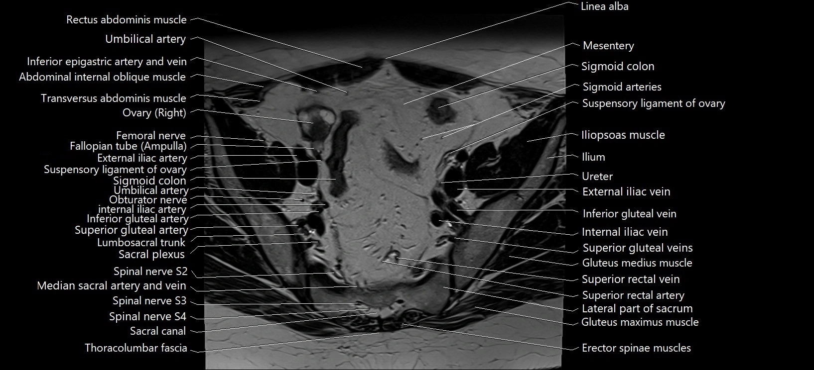 Axial cross sectional anatomy of female pelvis (MRI 3T) image 8.webp